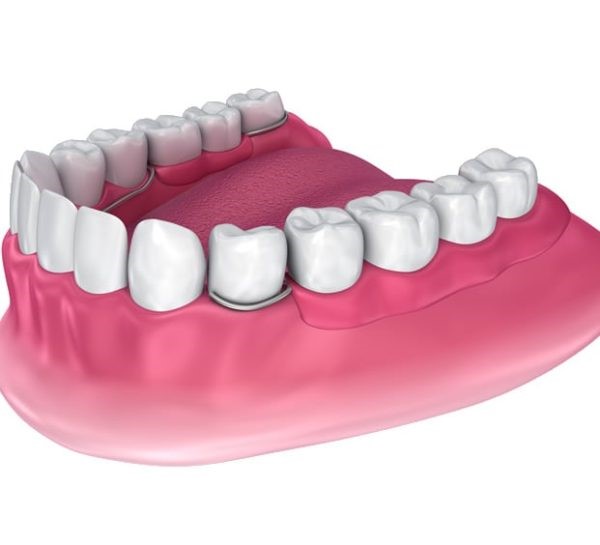 Kinds Of Dentures Evansville IN 47715